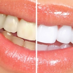 Dentistas em Santos - Thumb - Clareamento dental prejudica os dentes?