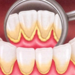 Dentistas em Santos - Thumb - O que causa o Cálculo ou Tártaro dental?