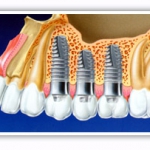 Dentistas em Santos - Thumb - Quem tem implantes pode usar aparelho ortodôntico?