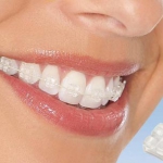 Dentistas em Santos - Thumb - Verdades e mentiras sobre o aparelho ortodontico estético