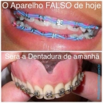 Dentistas em Santos - Thumb - Falso aparelho ortodôntico pode levar a perda de dentes