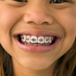 Dentistas em Santos - Thumb - Você sabe qual é a idade ideal para procurar um ortodontista?