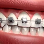 Dentistas em Santos - Thumb - Você Sabe Quais São os Benefícios da Ortodontia?