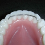 Dentistas em Santos - Thumb - A  importância das contenções pós-tratamento Ortodôntico