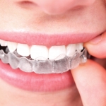 Dentistas em Santos - Thumb - Conheça as vantagens do aparelho ortodôntico Invisalign