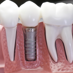 Dentistas em Santos - Implantodontia