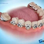 Dentistas em Santos - Thumb - Ortodontia ou Implante: o que devo fazer se eu perdi um dente?