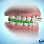 Dentistas em Santos - Thumb - Qual a diferença entre Ortodontia e Ortopedia funcional dos Maxilares?