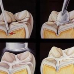 Dentistas em Santos - Thumb - Selante dental