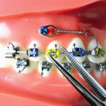 Dentistas em Santos - Thumb - Você já ouviu falar de Mini Implante?